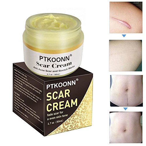 Narbencreme,Narbe gel,Narbenentfernung,Scar cream,Narbe Creme Narbe Behandlung,Scar Fade Cream,Behandeln Sie neue und alte Narben - Aknenarben, Dehnungsstreifen und Narben