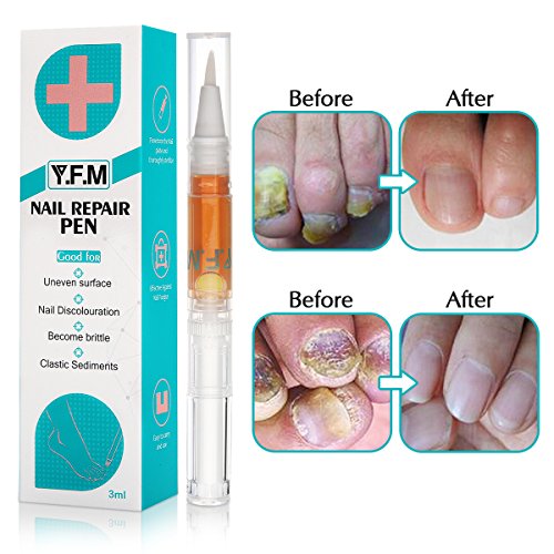Nagelpflege Stift, Y.F.M Nagel Behandlung, Zehennägel und Nagelpflege für gesunde Fuß und Hand